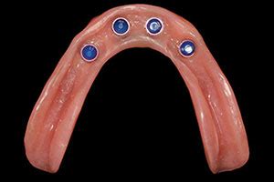 Simplifying Implant Overdentures: Contemporary  